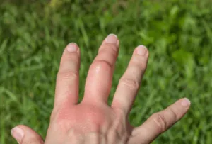 Mano gonfia in seguito a puntura di calabrone